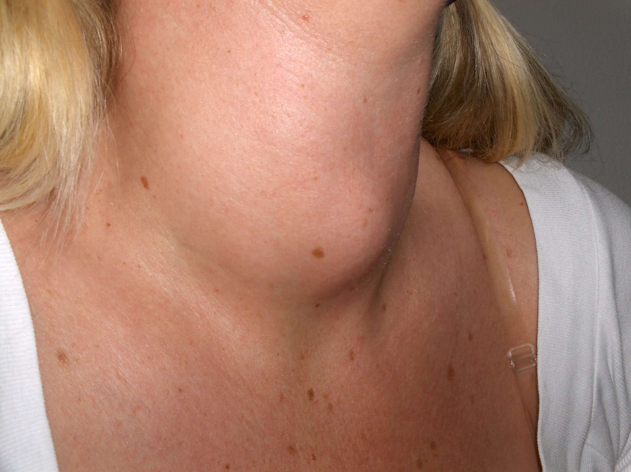 goitre-thyroïdien