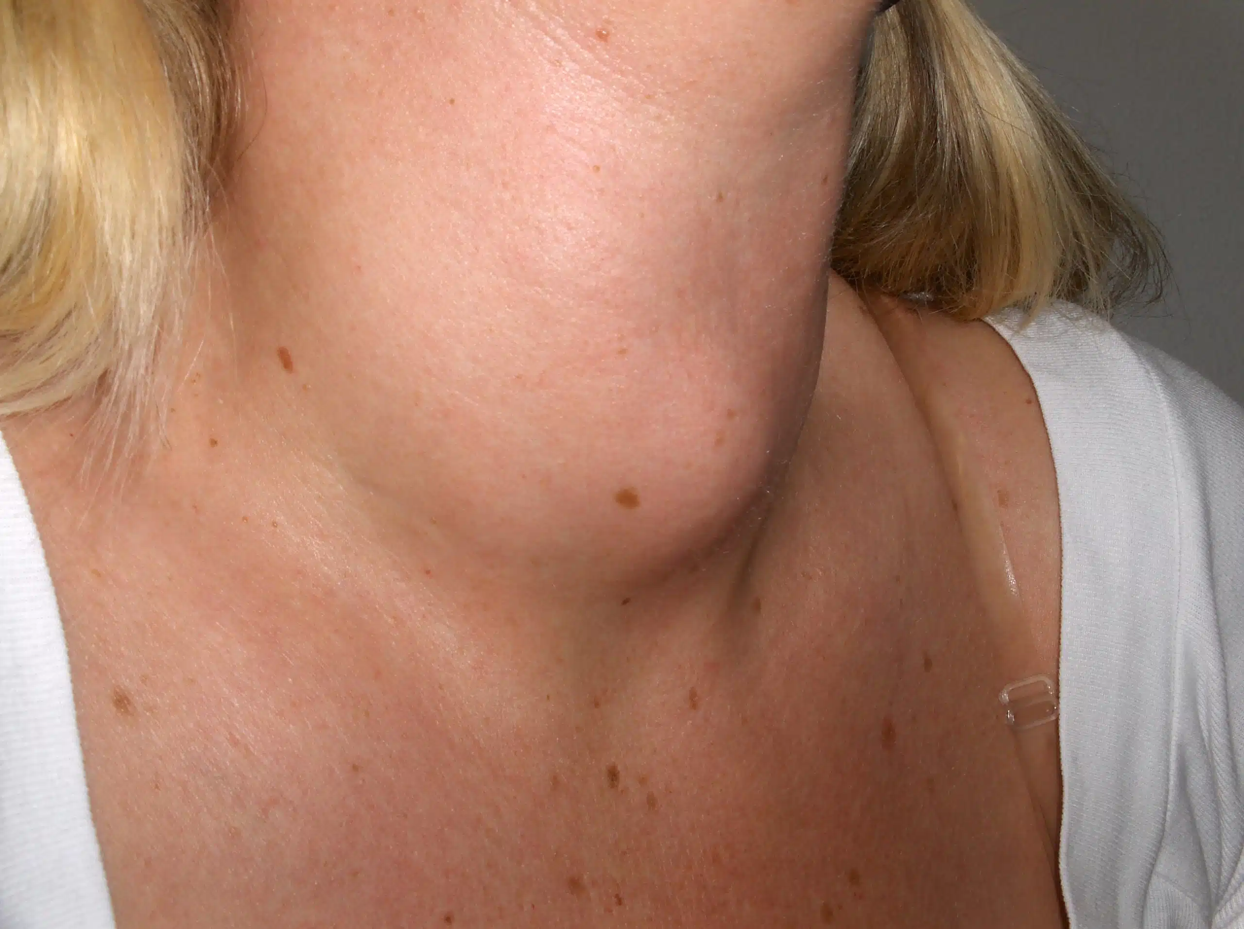 goitre-thyroïdien