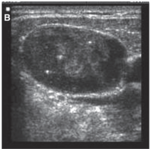 Ganglions cervicaux suspects à l’échographie : critères de malignité, cartographie ganglionnaire préopératoire et cytoponction avec thyroglobuline dans le cancer thyroïdien