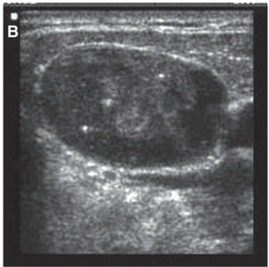 ganglion suspect